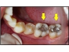 CUIDADO CON EL MERCURIO DE LOS EMPASTES DENTALES